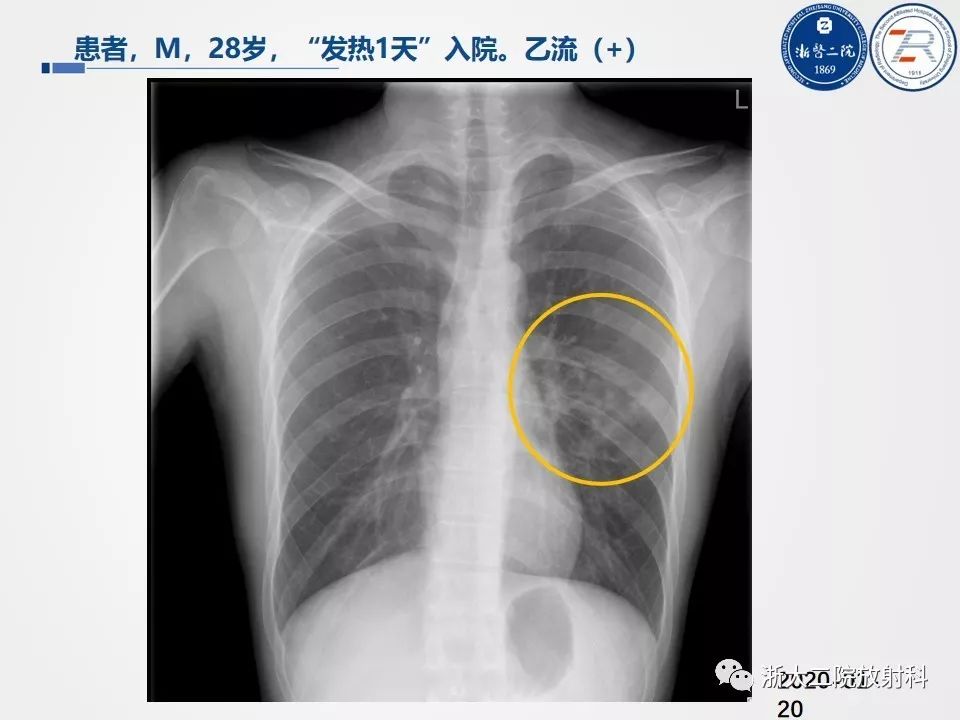 【PPT】新型冠状病毒肺炎影像学表现