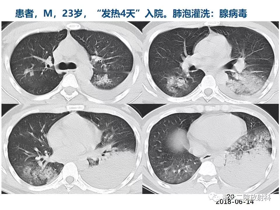 【PPT】新型冠状病毒肺炎影像学表现