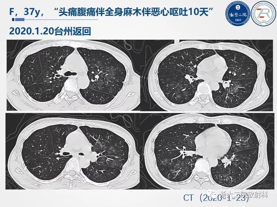 【PPT】新型冠状病毒肺炎影像学表现