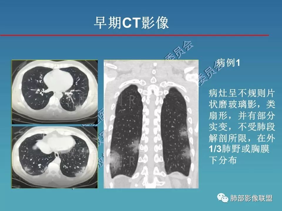 【PPT】新型冠状病毒肺炎（NCP）影像检查与诊断规范专家共识