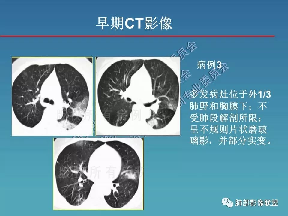【PPT】新型冠状病毒肺炎（NCP）影像检查与诊断规范专家共识