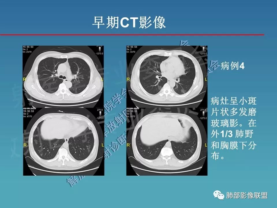 【PPT】新型冠状病毒肺炎（NCP）影像检查与诊断规范专家共识