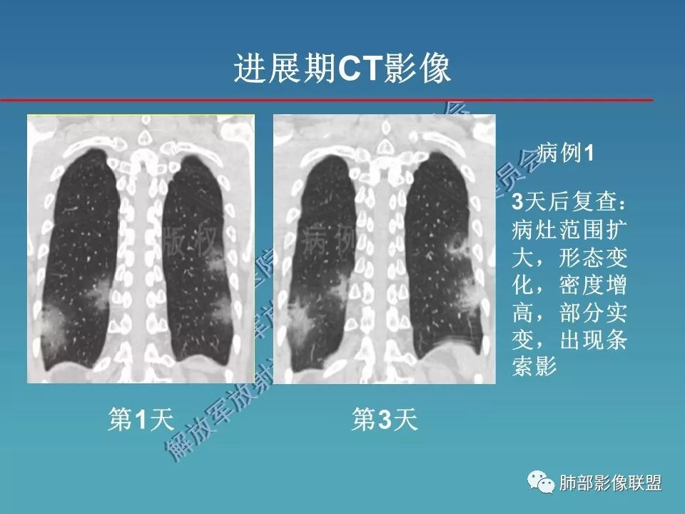【PPT】新型冠状病毒肺炎（NCP）影像检查与诊断规范专家共识