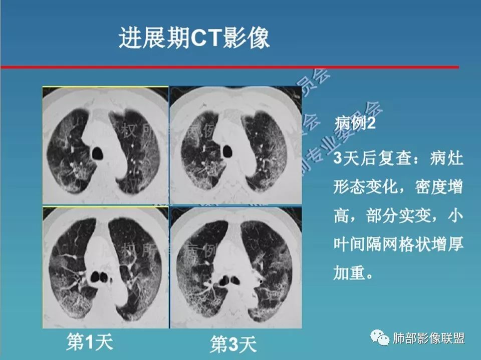【PPT】新型冠状病毒肺炎（NCP）影像检查与诊断规范专家共识