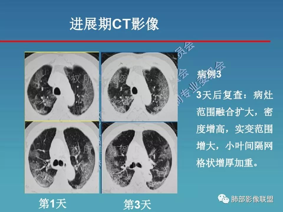 【PPT】新型冠状病毒肺炎（NCP）影像检查与诊断规范专家共识