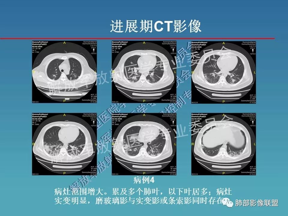 【PPT】新型冠状病毒肺炎（NCP）影像检查与诊断规范专家共识