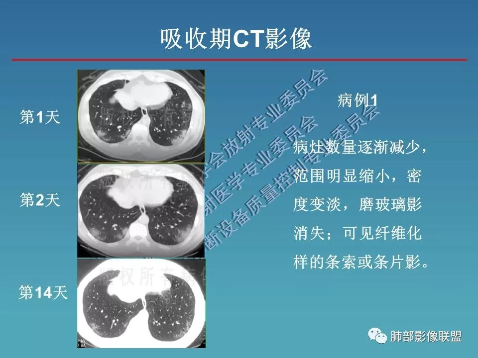 【PPT】新型冠状病毒肺炎（NCP）影像检查与诊断规范专家共识