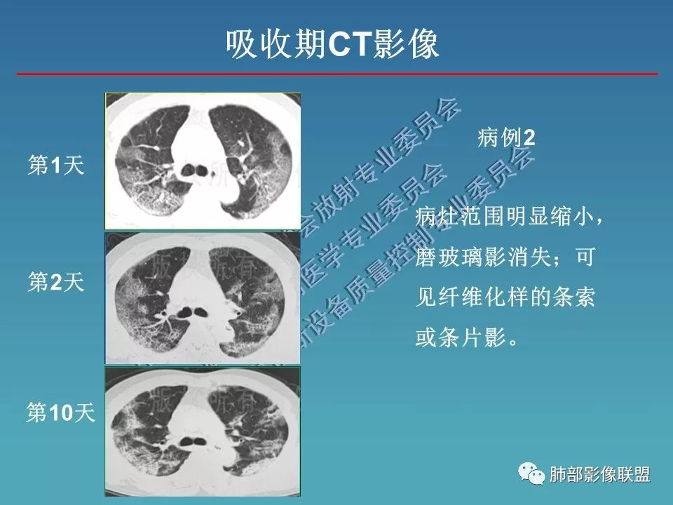 【PPT】新型冠状病毒肺炎（NCP）影像检查与诊断规范专家共识