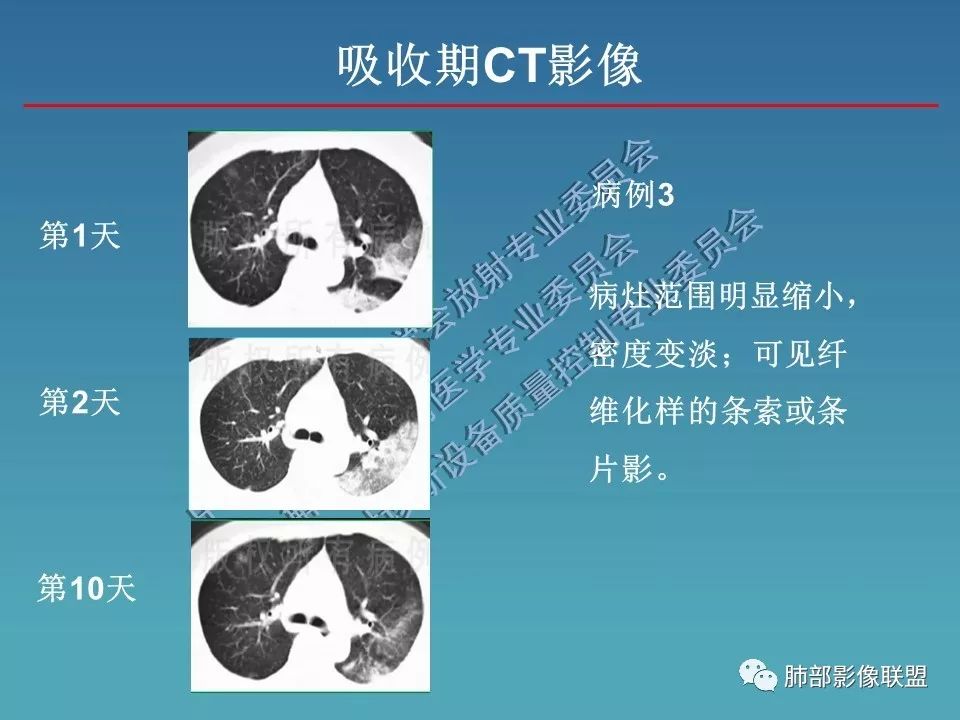 【PPT】新型冠状病毒肺炎（NCP）影像检查与诊断规范专家共识