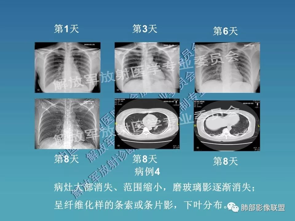 【PPT】新型冠状病毒肺炎（NCP）影像检查与诊断规范专家共识