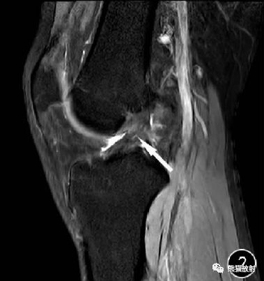 前交叉韧带损伤MRI 征象 前交叉韧带损伤MRI 征象