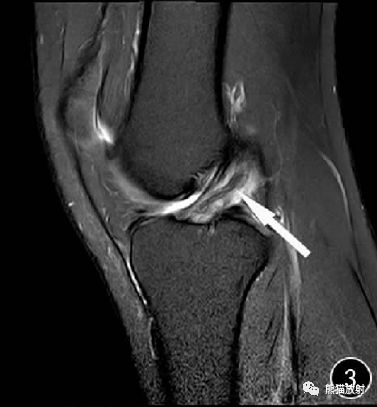 前交叉韧带损伤MRI 征象 前交叉韧带损伤MRI 征象