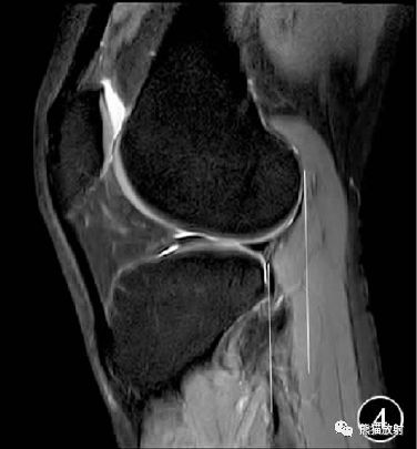 前交叉韧带损伤MRI 征象 前交叉韧带损伤MRI 征象