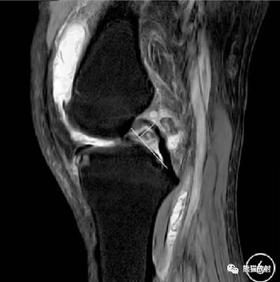 前交叉韧带损伤MRI 征象 前交叉韧带损伤MRI 征象