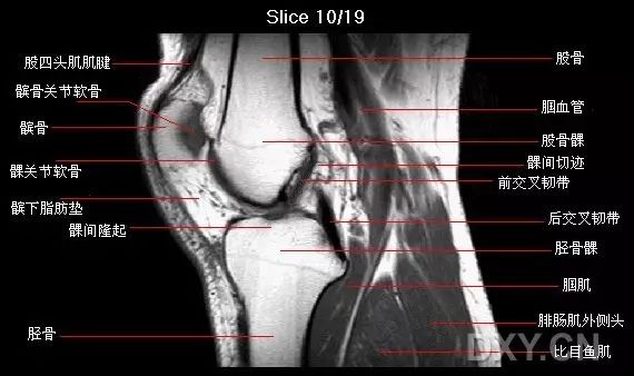 前交叉韧带损伤MRI 征象 前交叉韧带损伤MRI 征象
