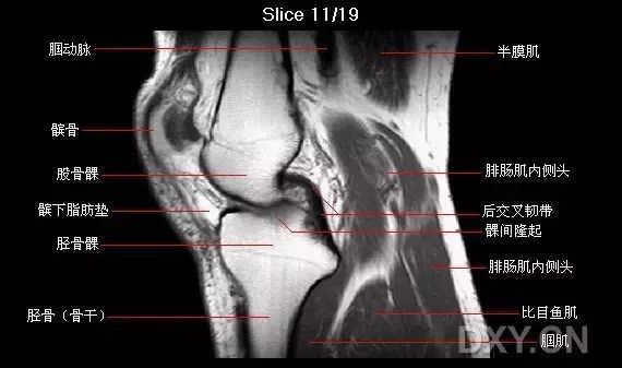 前交叉韧带损伤MRI 征象 前交叉韧带损伤MRI 征象