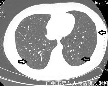 新冠状病毒肺炎影像学表现