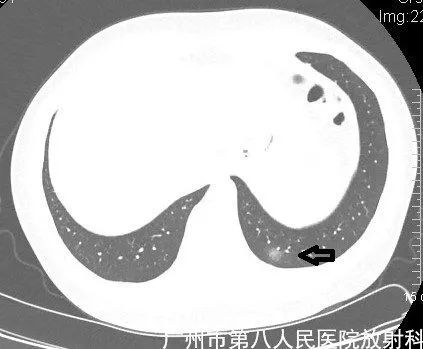 新冠状病毒肺炎影像学表现