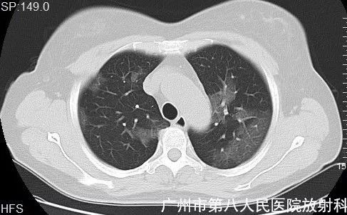 新冠状病毒肺炎影像学表现