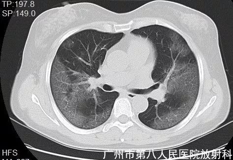 新冠状病毒肺炎影像学表现