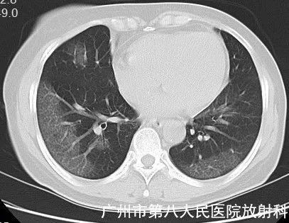 新冠状病毒肺炎影像学表现