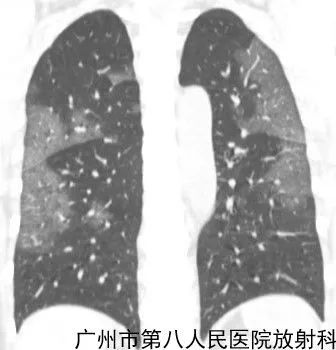 新冠状病毒肺炎影像学表现