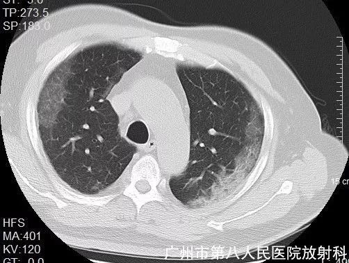 新冠状病毒肺炎影像学表现