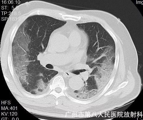 新冠状病毒肺炎影像学表现