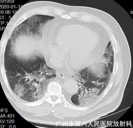新冠状病毒肺炎影像学表现