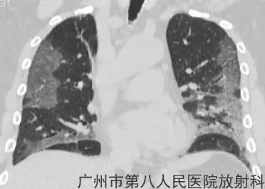 新冠状病毒肺炎影像学表现
