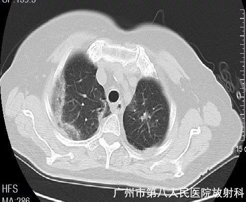 新冠状病毒肺炎影像学表现