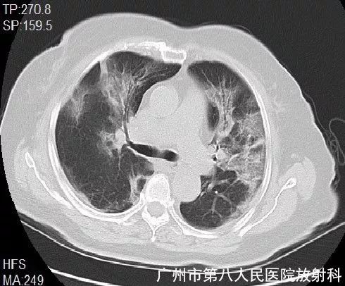 新冠状病毒肺炎影像学表现