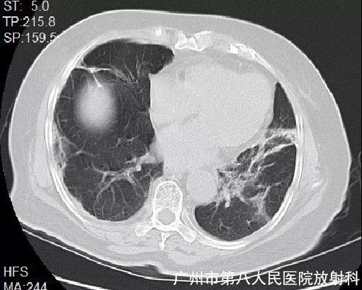 新冠状病毒肺炎影像学表现
