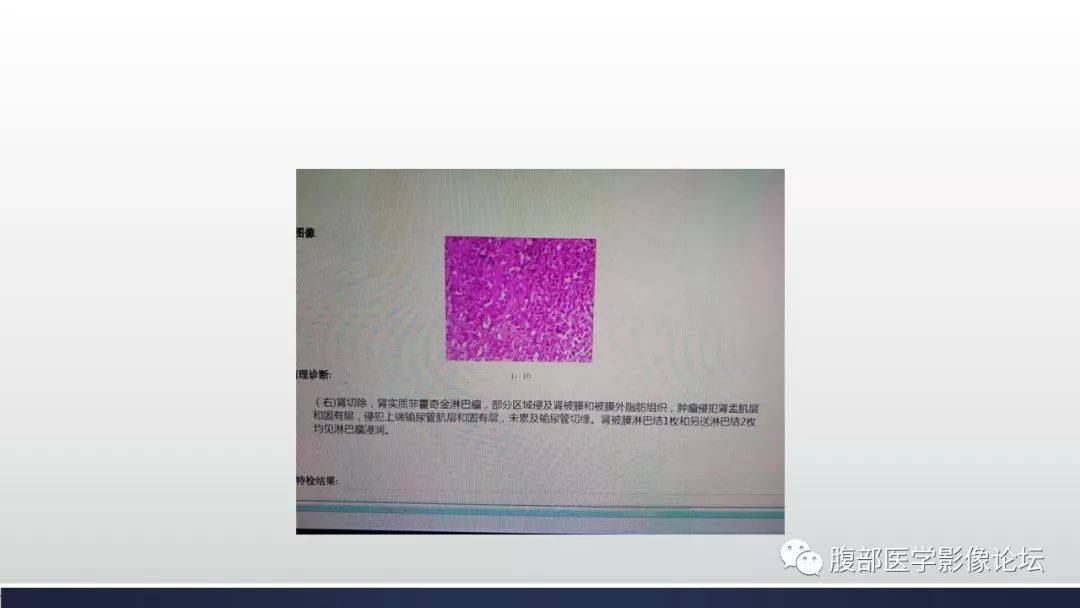 【病例】肾脏淋巴瘤1例CT影像