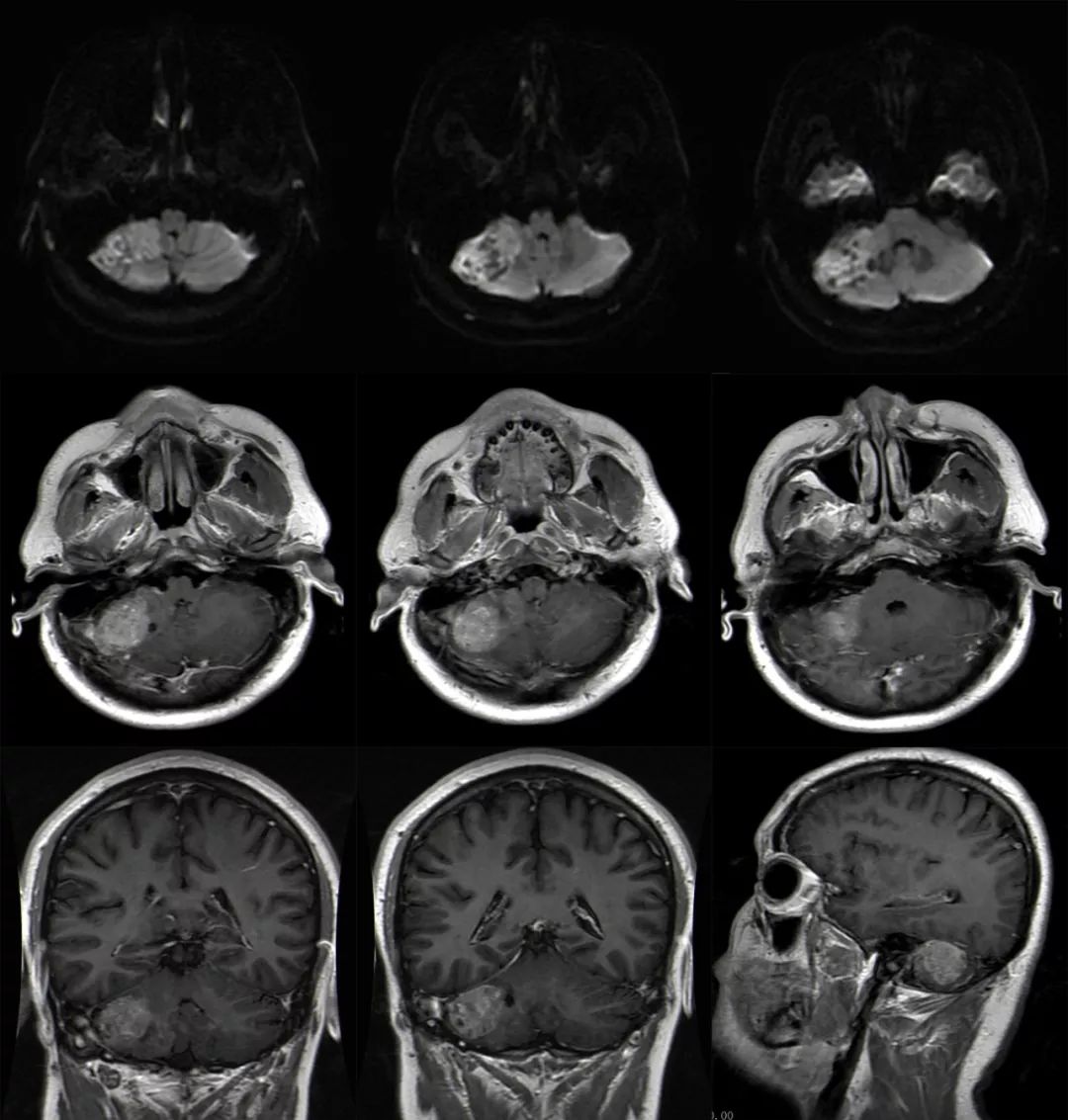 成人髓母细胞瘤的 MRI 表现 成人髓母细胞瘤的 MRI 表现