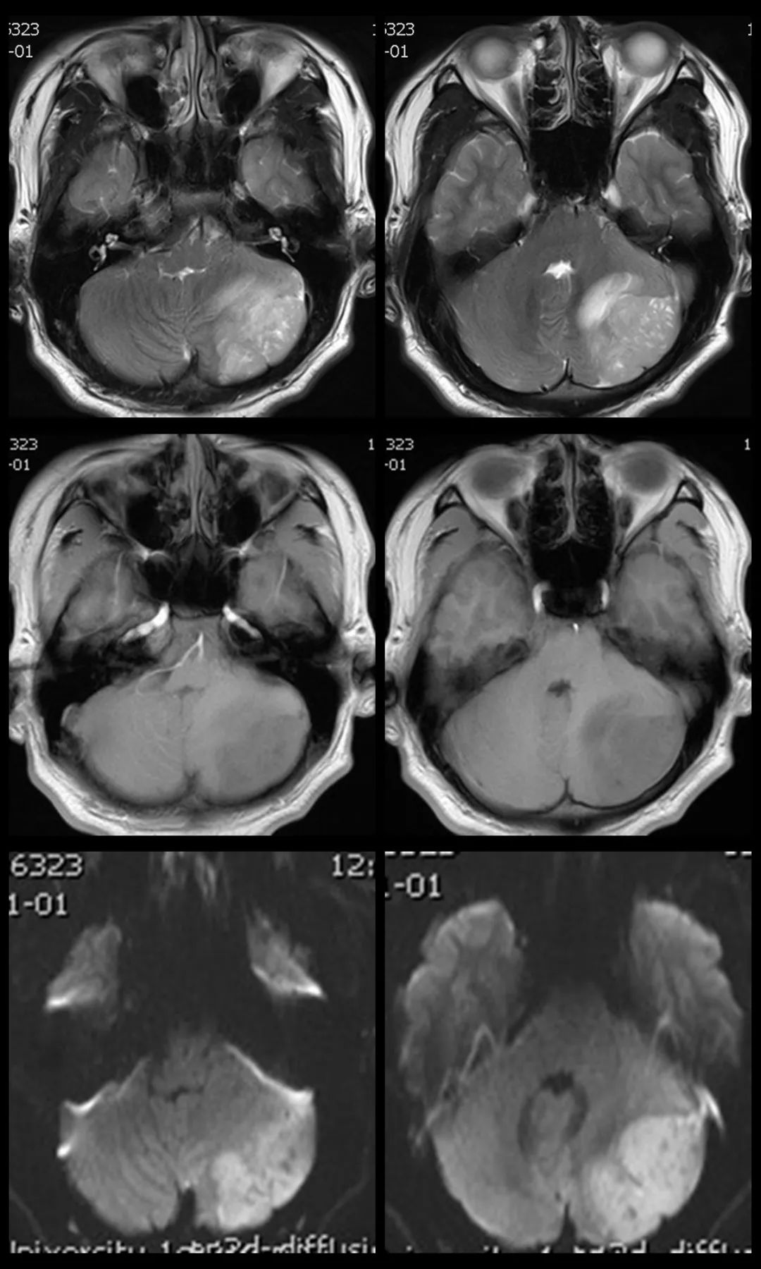 成人髓母细胞瘤的 MRI 表现 成人髓母细胞瘤的 MRI 表现