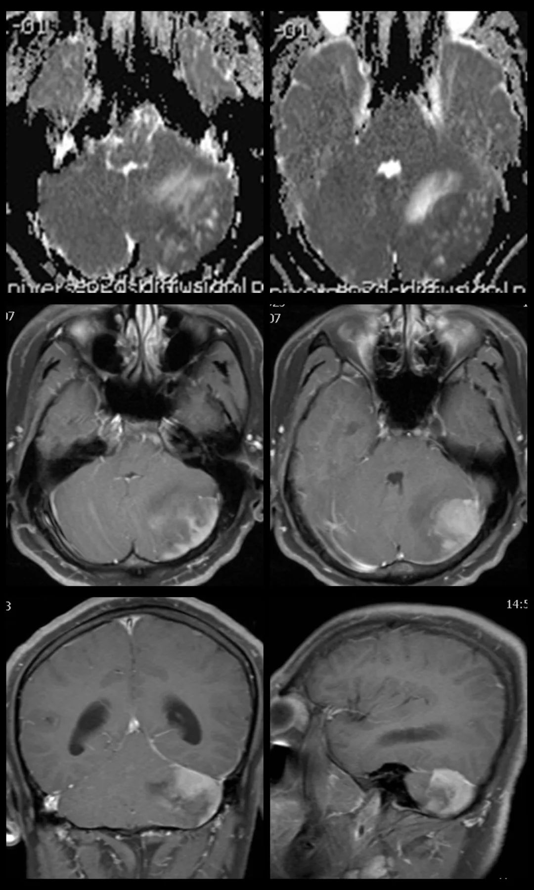 成人髓母细胞瘤的 MRI 表现 成人髓母细胞瘤的 MRI 表现