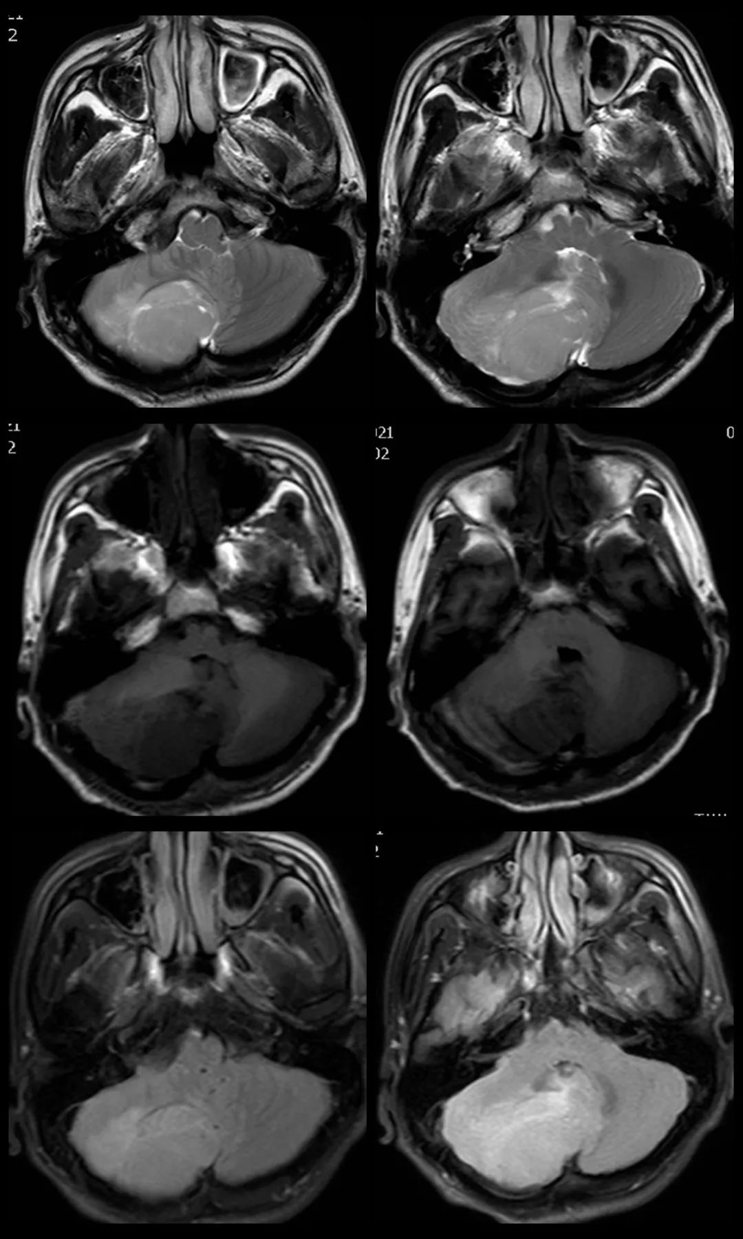 成人髓母细胞瘤的 MRI 表现 成人髓母细胞瘤的 MRI 表现