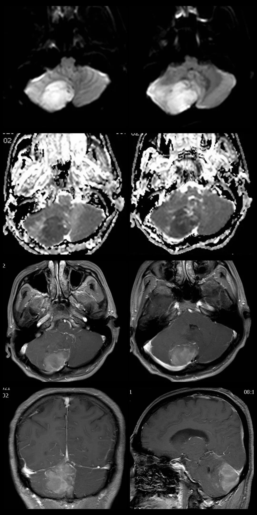 成人髓母细胞瘤的 MRI 表现 成人髓母细胞瘤的 MRI 表现