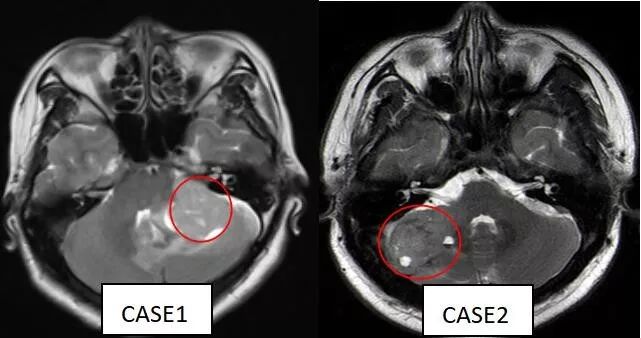 成人髓母细胞瘤的 MRI 表现 成人髓母细胞瘤的 MRI 表现
