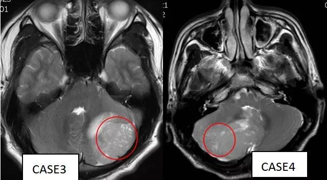 成人髓母细胞瘤的 MRI 表现 成人髓母细胞瘤的 MRI 表现