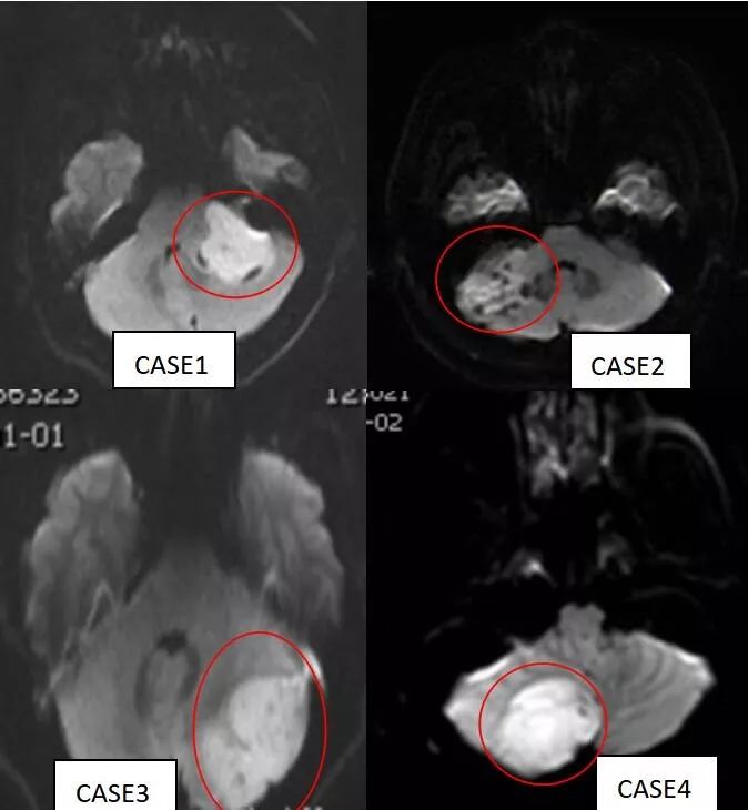 成人髓母细胞瘤的 MRI 表现 成人髓母细胞瘤的 MRI 表现