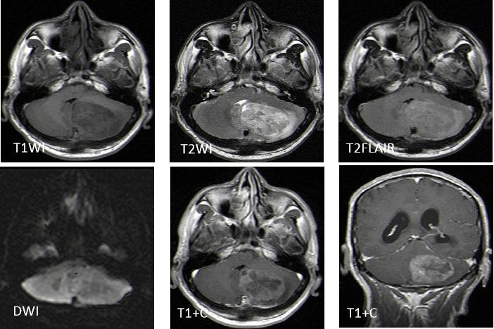 成人髓母细胞瘤的 MRI 表现 成人髓母细胞瘤的 MRI 表现
