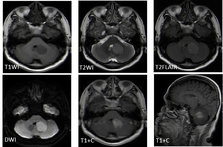 成人髓母细胞瘤的 MRI 表现 成人髓母细胞瘤的 MRI 表现