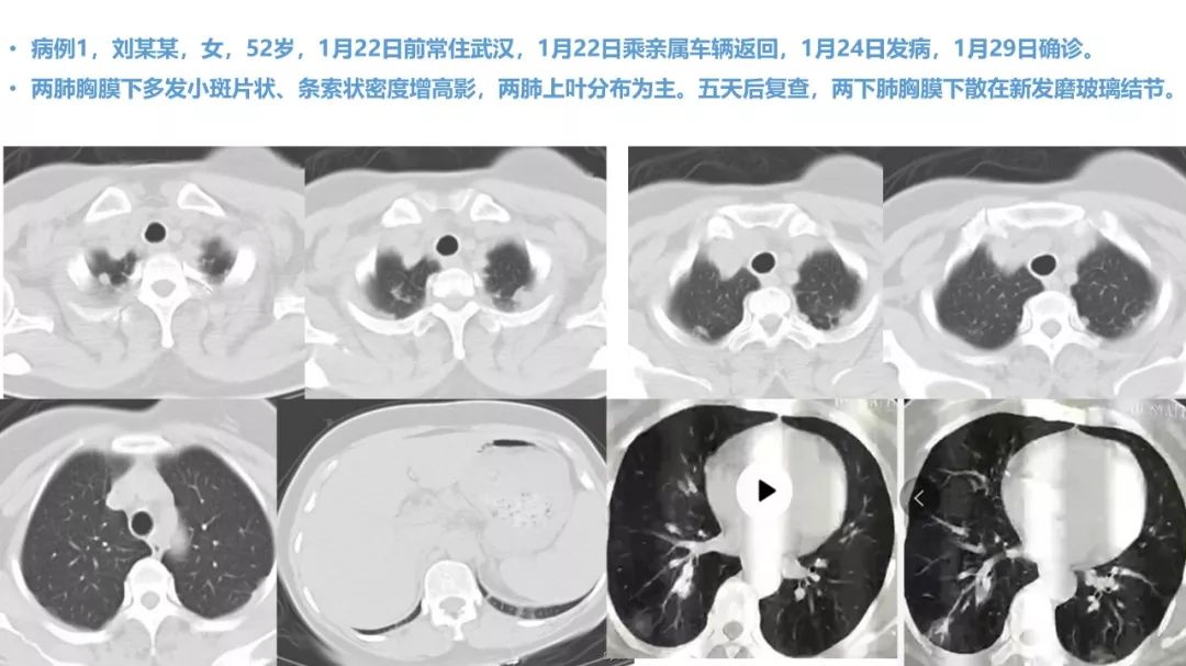 【PPT】新型冠状病毒肺炎NCP确诊病例汇总