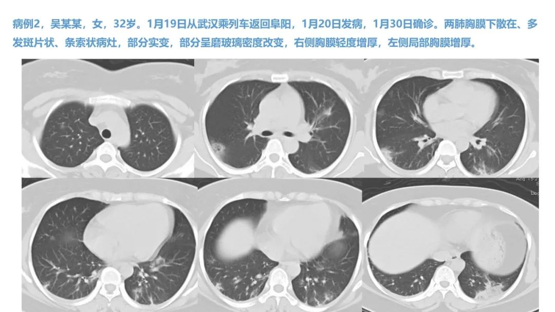 【PPT】新型冠状病毒肺炎NCP确诊病例汇总