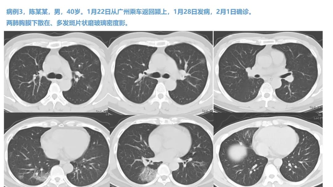 【PPT】新型冠状病毒肺炎NCP确诊病例汇总