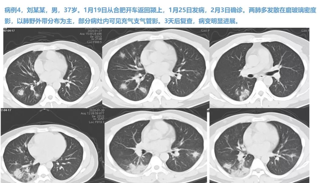 【PPT】新型冠状病毒肺炎NCP确诊病例汇总