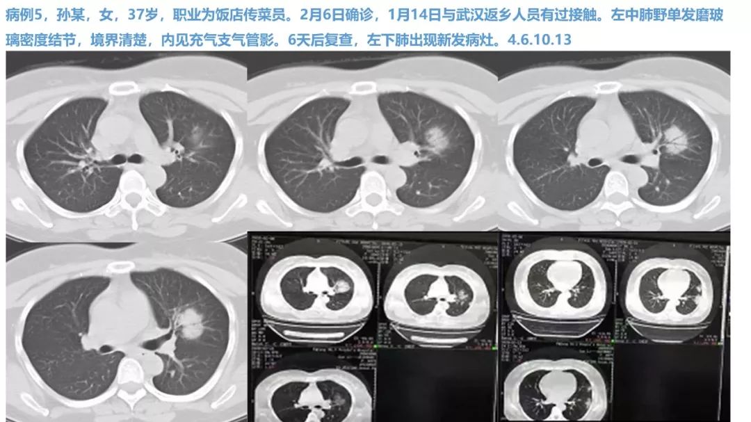 【PPT】新型冠状病毒肺炎NCP确诊病例汇总