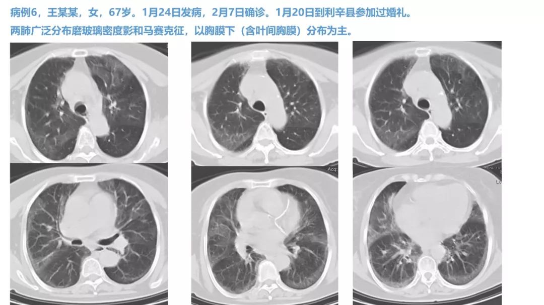 【PPT】新型冠状病毒肺炎NCP确诊病例汇总